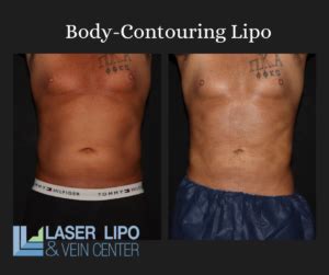 liposuction cost st louis|Top Liposuction Doctors in Saint Louis, MO